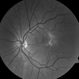 Epiretinal Membrane Epiretinal Membrane
