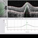 Retinal Pigment Epithelium Retinal Pigment Epithelium