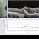 Retinal Pigment Epithelium Retinal Pigment Epithelium
