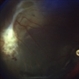 Retinal Tack Retinal Tack