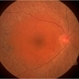 Retinitis Pigmentosa Retinitis Pigmentosa
