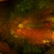 Retinitis Pigmentosa and Foveal Dragging Retinitis Pigmentosa and Foveal Dragging