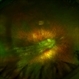 Retinitis Pigmentosa and Foveal Dragging Retinitis Pigmentosa and Foveal Dragging