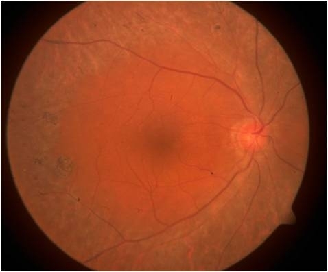 pigmentosa retinitis retina imagebank asrs