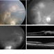 Retinoblastoma Retinoblastoma