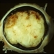 Retinoblastoma Retinoblastoma