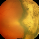 Rhegmatogenous Retinal Detachment  in Retinopathy of Prematurity Rhegmatogenous Retinal Detachment  in Retinopathy of Prematurity