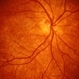 Rubella retinopathy Rubella retinopathy