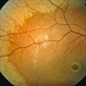 Niemann Pick Disease Type B Niemann Pick Disease Type B