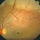 Niemann Pick Disease Type B Niemann Pick Disease Type B