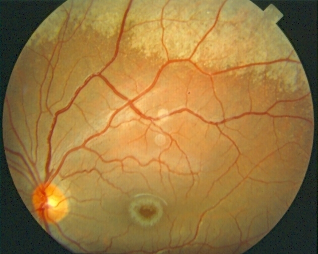 Niemann Pick Disease Type B - Retina Image Bank