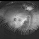 Scleral Buckle and Cryoptherapy Scar Scleral Buckle and Cryoptherapy Scar