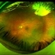 Scleral Buckle and Cryo Color Scleral Buckle and Cryo Color