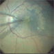 Vitreomacular Traction Vitreomacular Traction