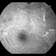 Sickle Cell Retinopathy with Sea Fans (angiography) Sickle Cell Retinopathy with Sea Fans (angiography)