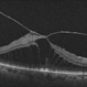 Severe vitreomacular traction Severe vitreomacular traction