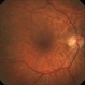 Severe vitreomacular traction Severe vitreomacular traction