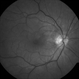 Severe vitreomacular traction Severe vitreomacular traction