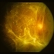 Severe Fibrovascular Proliferation From PDR Severe Fibrovascular Proliferation From PDR