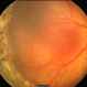 Skip Area in Retinopathy of Pretmaturity Skip Area in Retinopathy of Pretmaturity