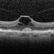 Stage 1 Macular Hole Stage 1 Macular Hole