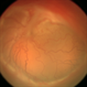 Stage 5 Retinopathy of Prematurity (ROP) Stage 5 Retinopathy of Prematurity (ROP)