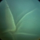 Sturge-Weber Syndrome: Total Exudative RD-RETCAM
