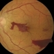 Subhyaloid Hemorrhage PDR OS Subhyaloid Hemorrhage PDR OS