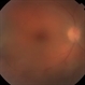 Toxoplasmosis