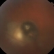 Toxoplasmosis Retinochoroiditis