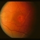 Traumatic Choroidal Rupture and Macular Hole