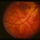 Traumatic Choroidal Rupture and Subretinal Hemorrhage