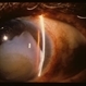 Traumatic Dislocation of Hypermature Cataract