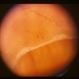 Traumatic Retinal Dialysis-RD Traumatic Retinal Dialysis-RD
