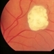 Tuberous Sclerosis Tuberous Sclerosis
