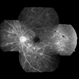 Occlusive Vasculitis Occlusive Vasculitis