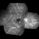 Occlusive Vasculitis Occlusive Vasculitis