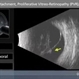 Total Retinal Detachment, PVR, Open Cone Total Retinal Detachment, PVR, Open Cone