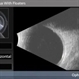 Attached Vitreous With Floaters Attached Vitreous With Floaters