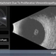 Total Retinal Detachment Due To Proliferative Vitreoretinopathy Total Retinal Detachment Due To Proliferative Vitreoretinopathy