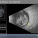 Asteroid Hyalosis, Vitreous Face Attached Asteroid Hyalosis, Vitreous Face Attached