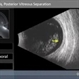 Asteroid Hyalosis, Posterior Vitreous Separation Asteroid Hyalosis, Posterior Vitreous Separation