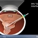25G PPV Without Scleral Buckling for RRD, PVR, Giant Breaks 25G PPV Without Scleral Buckling for RRD, PVR, Giant Breaks