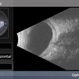 Uveitic Hypotony Uveitic Hypotony