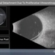 Tractional Retinal Detachment Due to Proliferative Vitreoretinopathy Tractional Retinal Detachment Due to Proliferative Vitreoretinopathy