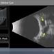 Communicating Orbital Cyst Communicating Orbital Cyst
