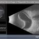 Vitreous & Subretinal Hemorrhage in Polypoidal Choroidal Vasculopathy Vitreous & Subretinal Hemorrhage in Polypoidal Choroidal Vasculopathy