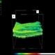 Macular pseudohole - 3D OCT reconstruction