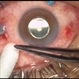 27-Gauge Vitrectomy 27-Gauge Vitrectomy