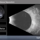 Acute Partial Vitreous Separation Acute Partial Vitreous Separation